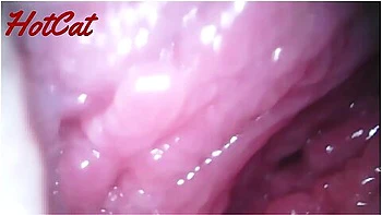 Endoscopic Vaginal Observation videos
